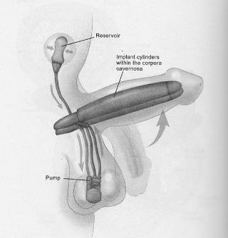 This image of a Penile Implant is from Abe's book