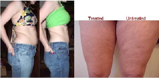 Topical Liposuction: A New Way To Lose Fat 1 Topical Lipo