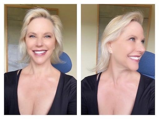 Hair Restoration